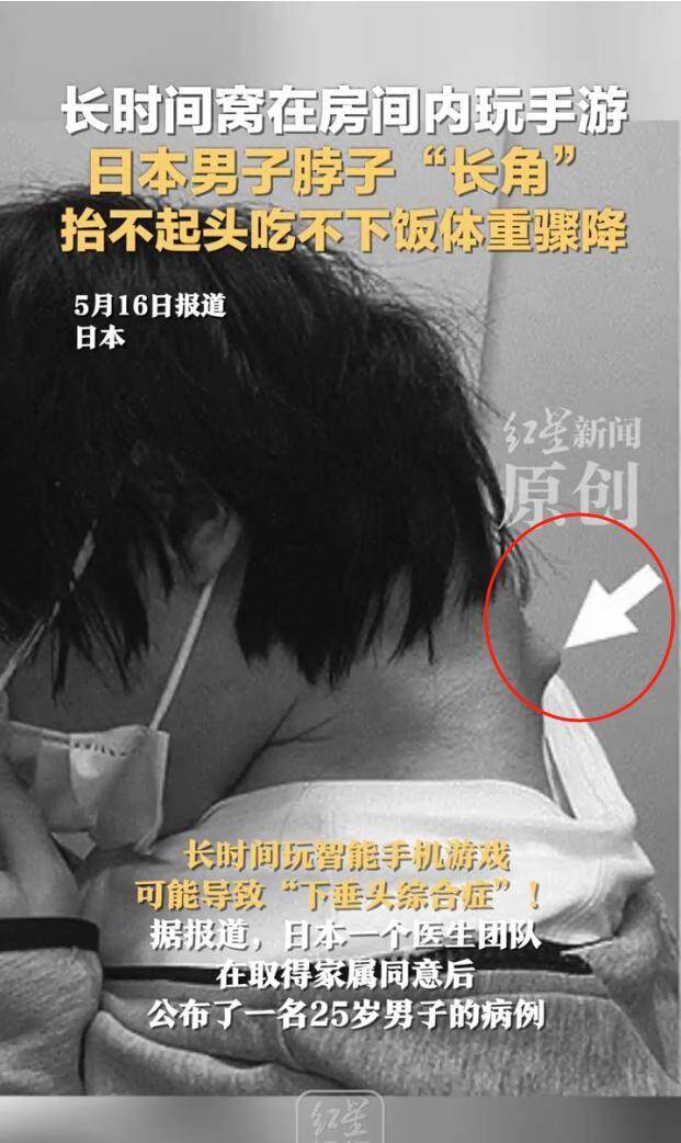 日本25岁男子沉迷手游致脖子长角